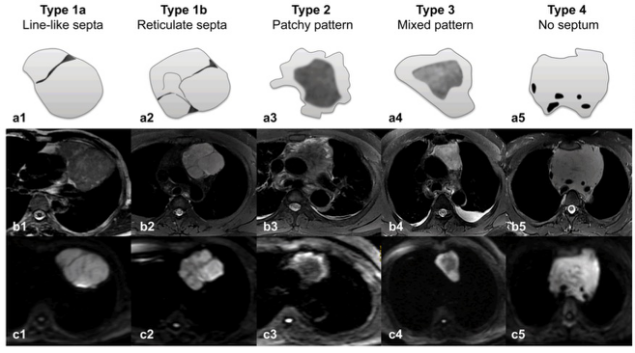 European Radiology：这些征象提示了什么？胸腺瘤、胸腺癌和淋巴瘤的影像学鉴别