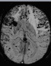 stroke：大脑淀粉样血管病变相关炎症的临床、神经影像和遗传标志物