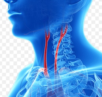 SVN：前瞻性多中心队列中颈动脉颅外段自由漂浮血栓的病因分析
