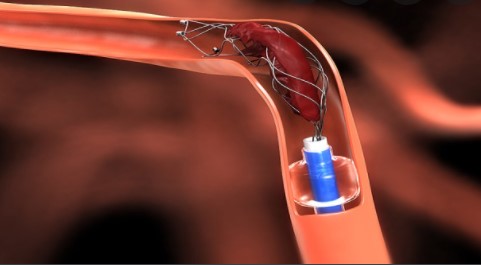 Stroke：刘建民教授：血管闭塞部位是否会对血栓切除术前静脉溶栓有影响？