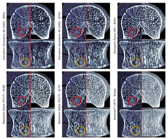 Investigative Radiology：PCCT用于骨小梁结构成像的能力