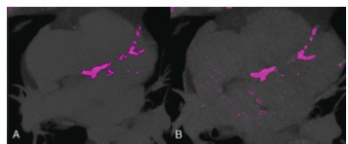 Investigative Radiology：基于血管造影的CCTA<font color="red">钙化</font>评分在临床第一代PCD-CT上的应用