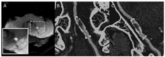 European Radiology：高分辨率血管壁成像预测血管成形术和支架置入对颅内动脉狭窄的影响
