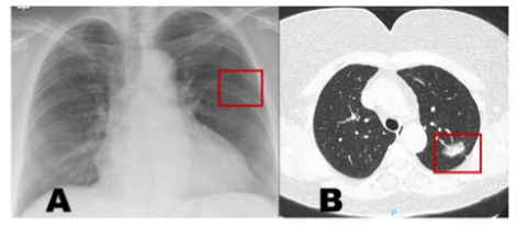 European Radiology：<font color="red">心脏</font>手术前常规CT扫描和胸片中的偶然发现