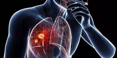 Lancet Respir Med：Lorlatinib一线治疗ALK+晚期非小细胞肺癌的疗效明显优于克唑替尼