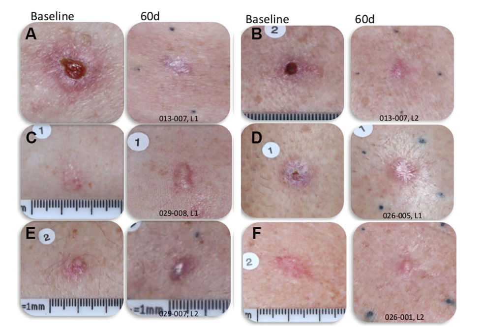 front oncol:纳米脉冲刺激64技术治疗结节性和浅表性低危基底细胞癌