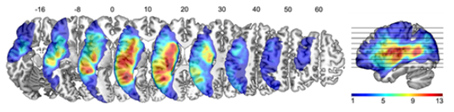 HUMAN BRAIN MAPPING：非优势侧丘脑-皮层功能连接介导的脑灌注影响失语症患者的命名能力