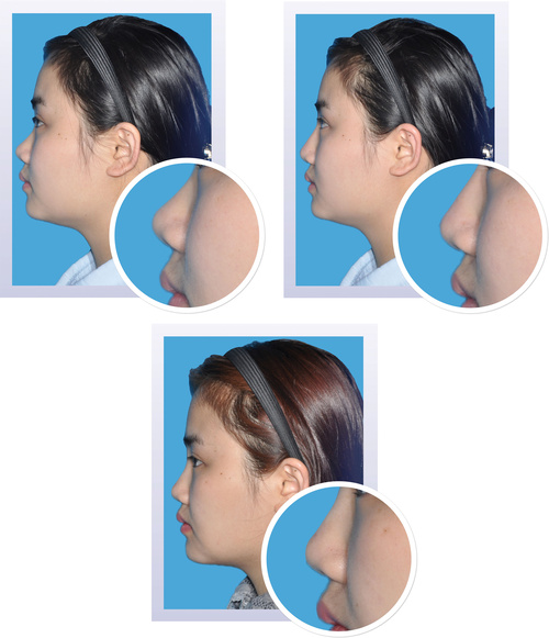 PRS：多中心随机、非治疗对照的鼻背和鼻根形态美学研究