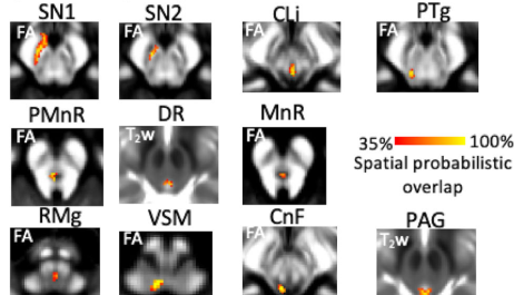 Mov Disord.:7T磁共振发现REM期睡眠行为障碍患者脑干核间结构连接受损