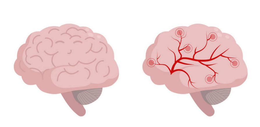 Phytomedicine：注射用益气复脉(冻干)通过抑制神经元自噬，减轻<font color="red">脑缺血</font><font color="red">损伤</font>