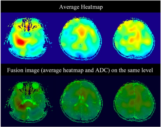 European Radiology：深度学习，让使用常规MRI进行自闭症<font color="red">诊断</font>成为可能！