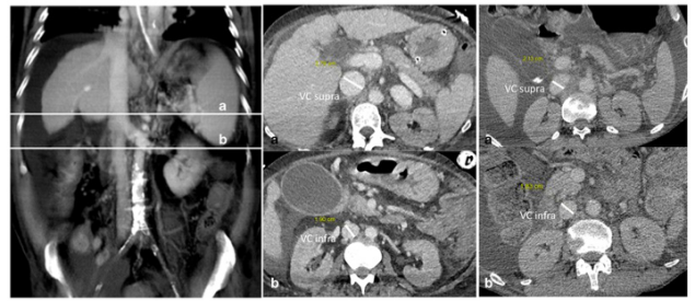 European Radiology：术前CT扫描有助于预测肝移植术后肝功能衰竭患者的预后