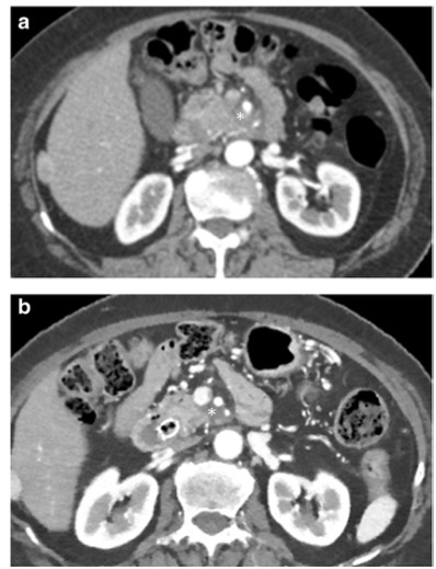 European Radiology：使用CT和肿瘤标记物评估胰腺癌新辅助治疗后的可切除性