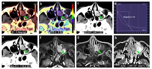 European Radiology：双能量CT在鼻腔良、恶性病变中的应用