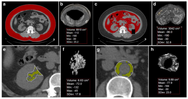 European Radiology：只需测一测CT图像的这个位置，代谢综合征就无处遁形！