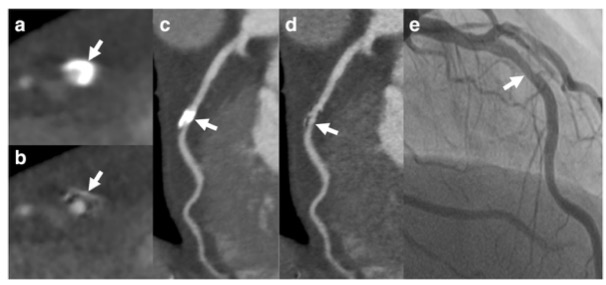 European Radiology：严重钙化的冠脉究竟要如何评估狭窄程度？CTA有了新办法！