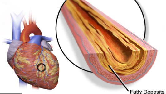 EHJ：靶向蛋白质组学可以改善二级预防中的心血管风险预测