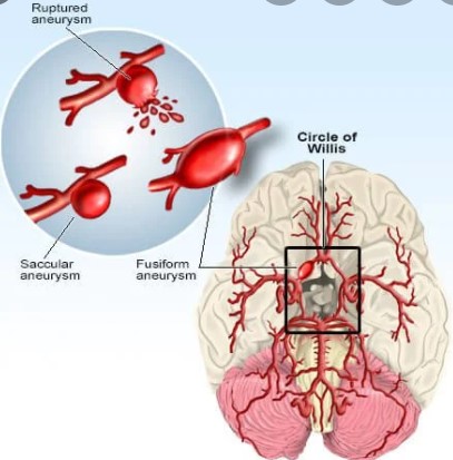 Stroke：有蛛网膜下腔出血家族<font color="red">史</font>者，如何预测自己的出血风险？