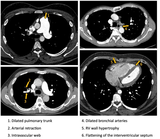 European Radiology：究竟哪些影像学征象可以提示慢性血栓栓塞性肺动脉高压的存在？