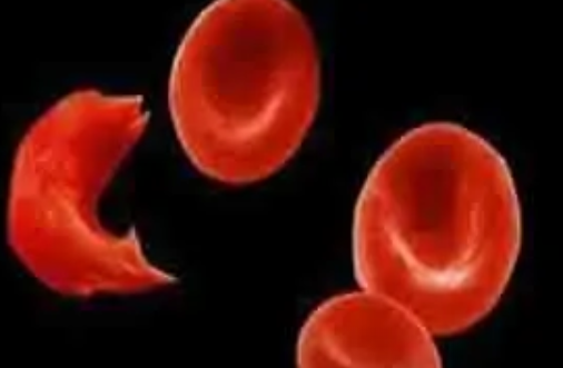 <font color="red">NEJM</font>：LentiGlobin基因疗法治疗镰状细胞病