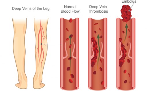 BMJ：除了<font color="red">下肢</font>血管彩超，小小D二聚体也能提示深静脉血栓形成！