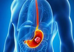 Gastric Cancer: 阿司匹林与胃腺癌术后长期生存的关系