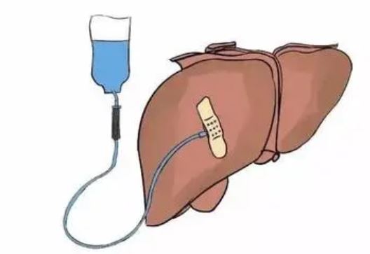 Hepatology：肝细胞癌<font color="red">根治</font><font color="red">性</font>肝切除术后复发的动态风险预测