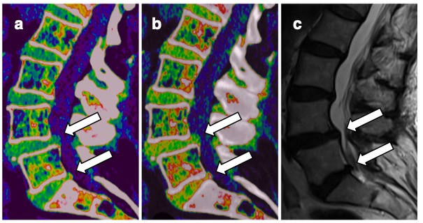 European Radiology:双能量CT在评估腰椎间盘突出症中的<font color="red">诊断</font><font color="red">准确性</font>