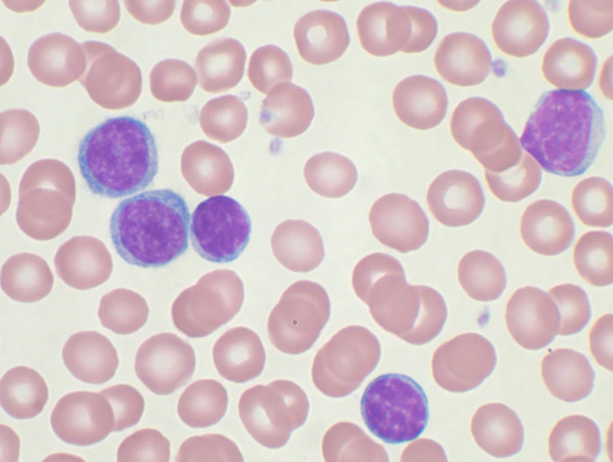 FDA叫停Ukoniq治疗慢性淋巴<font color="red">细胞</font><font color="red">白血病</font>的临床试验