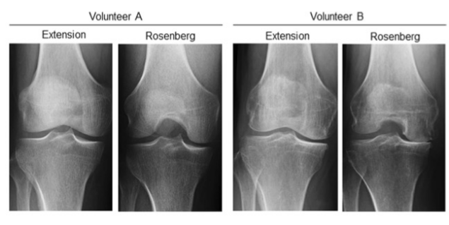 European Radiology：不同体位拍摄的X线片对膝关节内侧间隙的显示有<font color="red">何</font>差异？