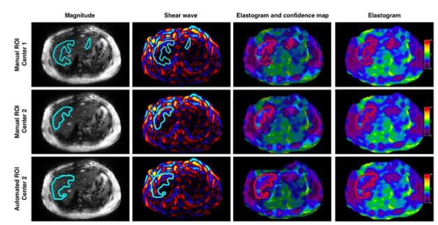 Radiology：不同中心的MR弹性成像在非酒精性脂肪肝中的应用