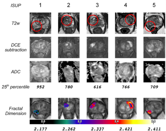Radiology：前列腺MRI分形分析和<font color="red">PI</font>-<font color="red">RADS</font>在前列腺癌分级中的应用