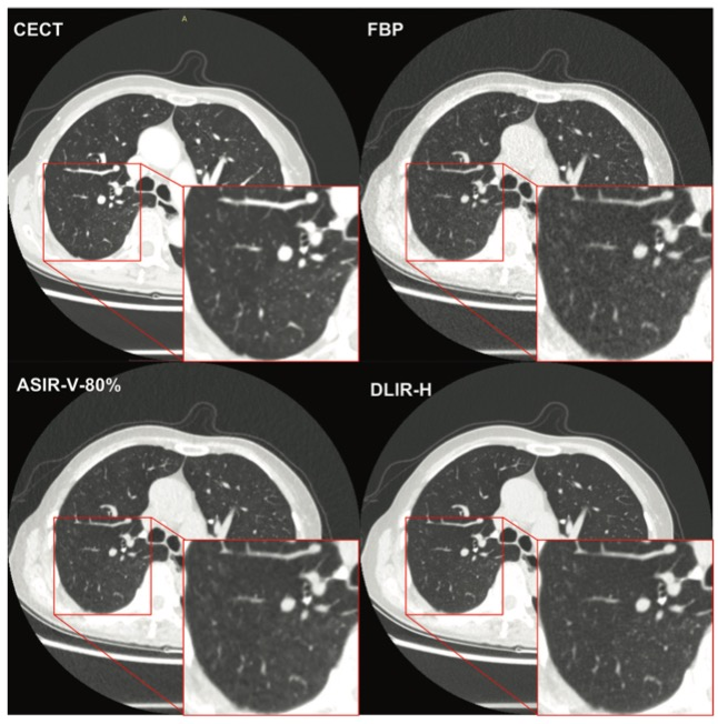 Radiology：在<font color="red">超低剂量</font>胸部<font color="red">CT</font>中，深度学习可实现肺结节的“既要、又要、还要”