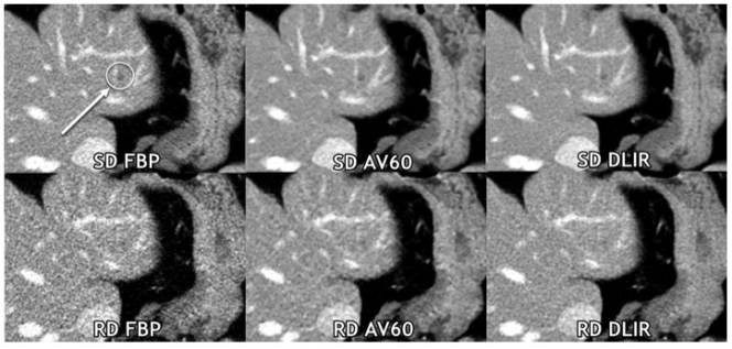 Radiology：肝脏转移瘤腹部CT的低剂量深度学习重建