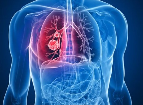 国家癌症中心/中国医学科学院：单次LDCT筛查即可降低1/3肺癌死亡风险！