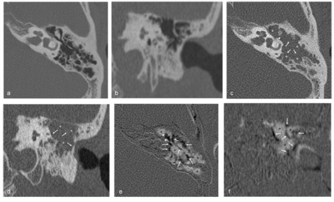 European?Radiology：這一技術(shù)，實(shí)現(xiàn)了中耳膽脂瘤乳突延伸的術(shù)前預(yù)測！