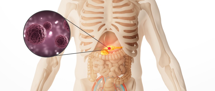 European Radiology：偶然发现胰腺小囊肿究竟该如何让处理？