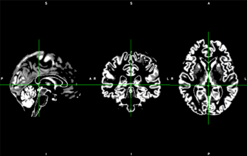 HBM:基于结构 MRI 的脑特征鉴别<font color="red">MCI</font>、PMCI 和 AD