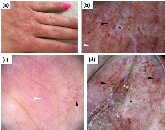 JEADV：Gottron丘疹和其他累及手背的炎症性皮肤病的皮肤镜检查