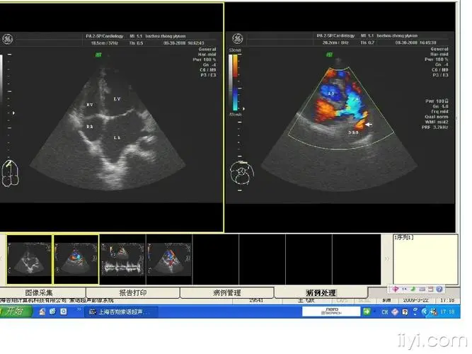BMJ子刊：极早产儿动脉导管未闭的处理