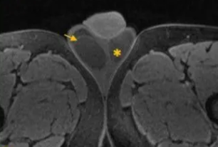 J Clin Oncol：用MRI替代CT以及拉长复查间隔对I期精原细胞瘤患者的长期预后无不良影响