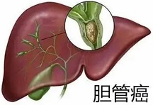 Clin Cancer Res：雷莫芦单抗治疗晚期胆道癌的疗效和<font color="red">安全性</font>