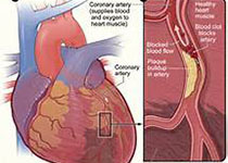 JAHA：慢性血管扩张剂对血管痉挛性心绞痛患者预后的影响