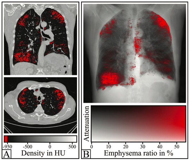 Radiology：暗视野胸片，使肺气肿实现快速的定性和定量