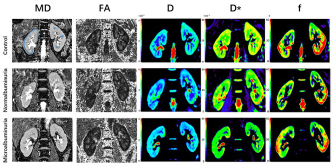 European Radiology:<font color="red">IVIM</font>和DTI在无创检测2型糖尿病早期肾损伤的方面的价值