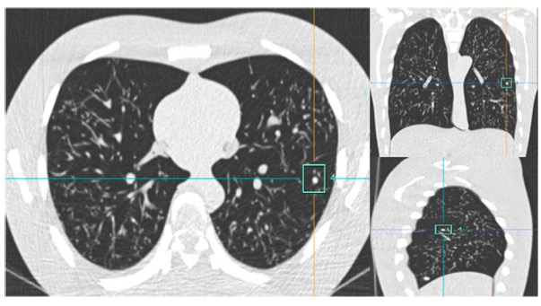 European Radiology:对肺<font color="red">结节</font>的筛查，低剂量胸部CT究竟该如何选择？