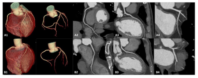 European Radiology:深度学习，让冠状动脉CT血管造影实现“双减”！