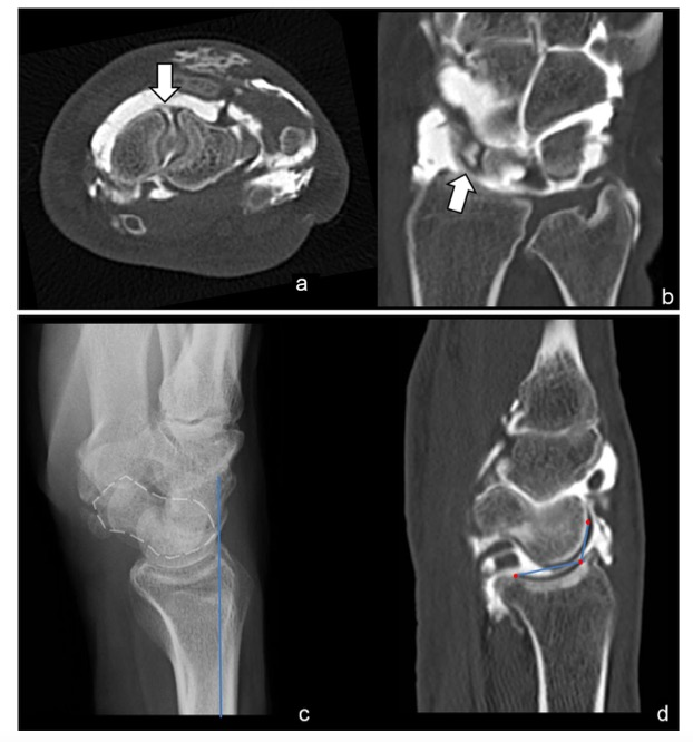 European Radiology：舟骨韧带撕裂患者的影像学评估：定量评估的选哪个?