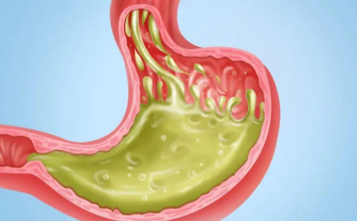 Clin Gastroenterol Hepatol：睡眠体位疗法可有效缓解夜间胃食管反流症状