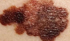 JAMA Dermatol：全球2020年皮肤黑<font color="red">色素</font>瘤的发病率和死亡率